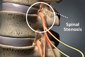Cervical Spinal Stenosis Physiotherapy - IRHC
