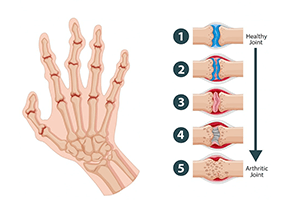 Physiotherapy 21 Rheumatoid Physiotherapy - IRHC